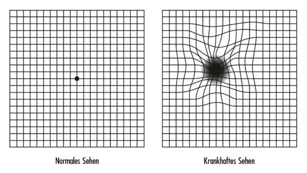 AGE-RELADED_MAKULADENERATION_AMD_AMSLER_TET-600X338