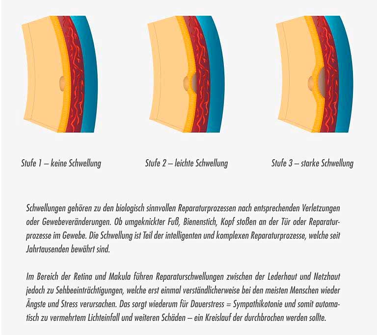 AGE -Related_Makuladegeneration_amd_schwellung_der_Makula
